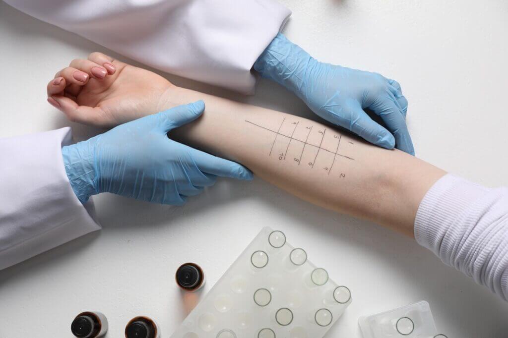 Allergy skin prick test being performed on patient's arm